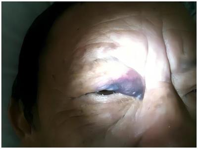 Postoperative ecchymoma of eyelid after botulinum toxin injection for hemifacial spasm: a case report